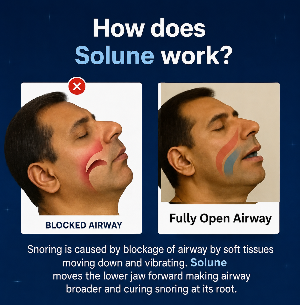 Solune mouthpiece